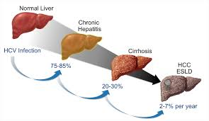 Hep C and HCC