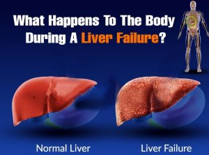 Hep C and liver failure