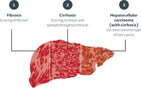 is liver cirrhosis reversible