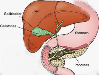 Hepatitis C and gallstones