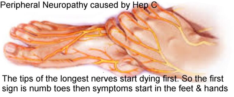 Hep C and Peripheral Neuropathy