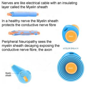 Hep C induced neuropathy can cause serious nerve damage